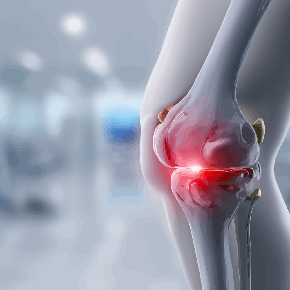 Kök Hücre ile Kireçlenme (Osteoartrit) Tedavisi